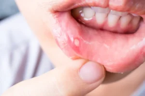 Aphthous ulcer